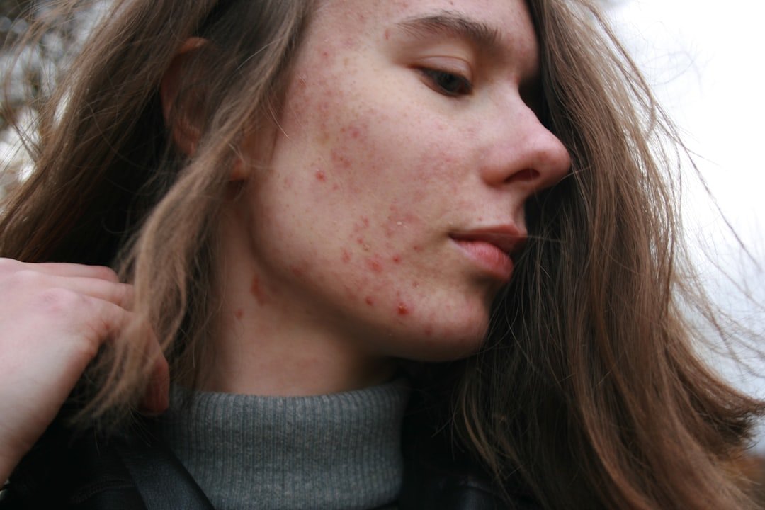 Photo Adult Acne